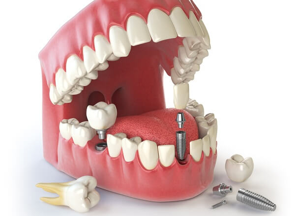 CẤY GHÉP IMPLANT CÓ ĐAU KHÔNG?